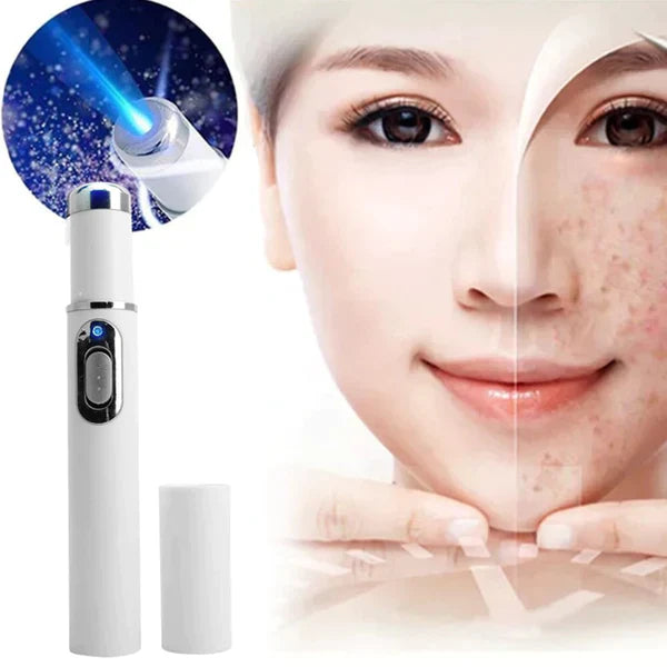Caneta Laser Tratamento de Varizes e Acne Original
